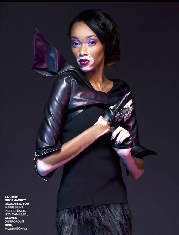 Winnie Harlow, Black Models Vitiligo, Winnie Harlow America's Next Top Model, NORD Magazine, Vitiligo Dark Skin
