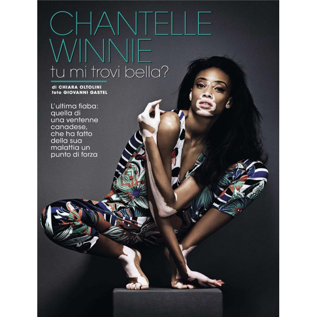 Chantelle Winnie Glamour Italia Giovanni Gastel Models with Vitiligo Black Fashion Models